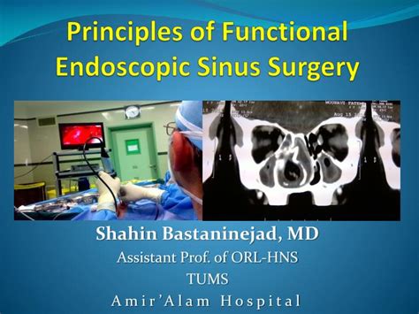 Ppt Principles Of Functional Endoscopic Sinus Surgery Powerpoint