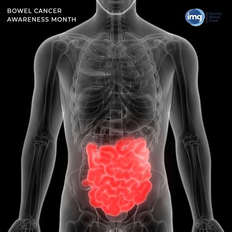 Bowel Cancer Awareness Month This June Lets Learn How Early