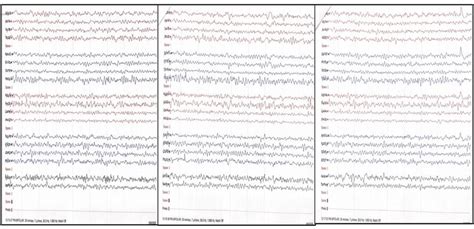 Eeg Result Showed Normal Alpha Background Activity At 8 To 10 Htz