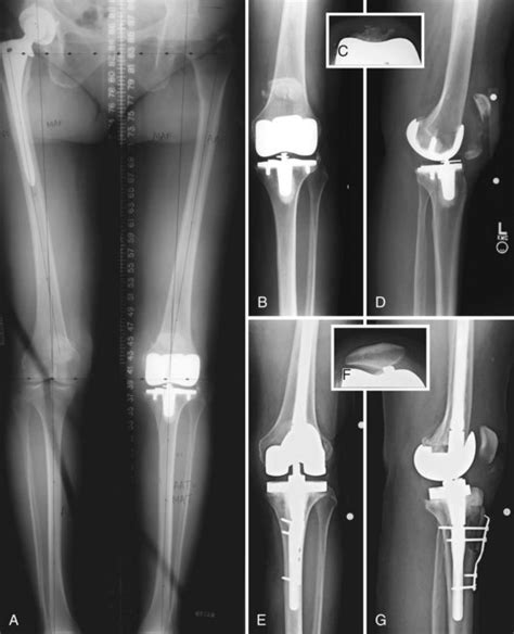 Extensor Mechanism Disruption After Total Knee Arthroplasty