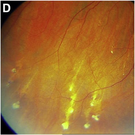 Ocular Manifestations Of Genetic Skin Disorders Clinics In Dermatology
