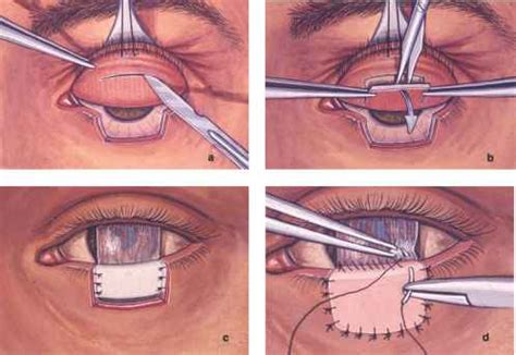 Hughes Tarsoconjunctival Flap Procedure Eyelid Diseases