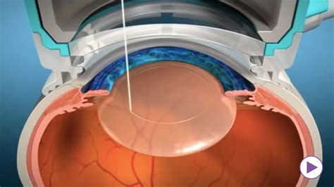 Femtosecond Laser Cataract Surgery Procedure And Benefits