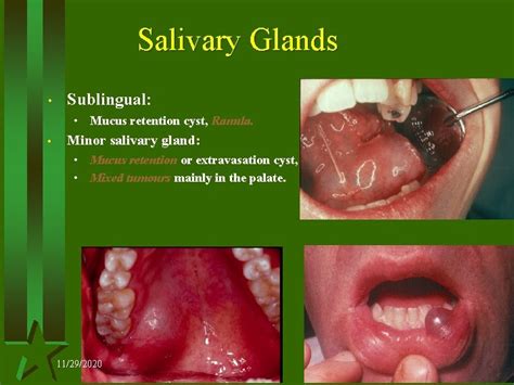 Salivary Glands Submandibular Salivary Gland Is A Large