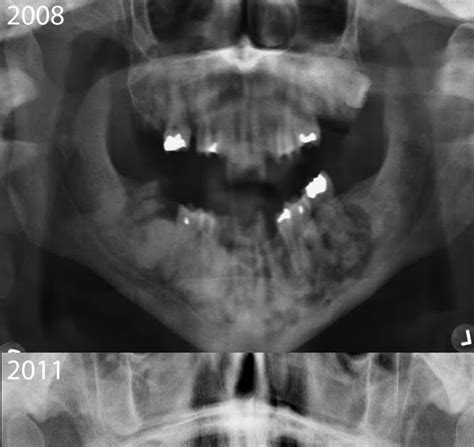 The correct answer is a. Roentgen Ray Reader: Cemento-Osseous Dysplasia
