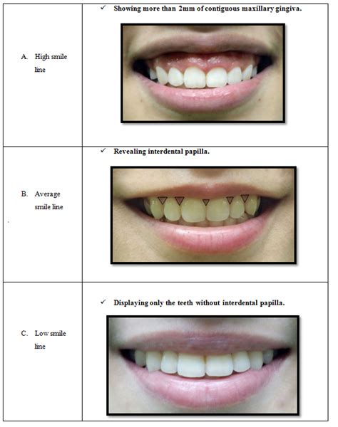 The Relationship Between The Lip Length And Smile Line In A Malaysian