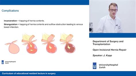 Carlson, md department of surgery university of nebraska medical center omaha va medical center omaha, nebraska unmc dept surgery grand rounds. Open Incisional Hernia Repair - Please participate in our 3-minute survey below! - YouTube