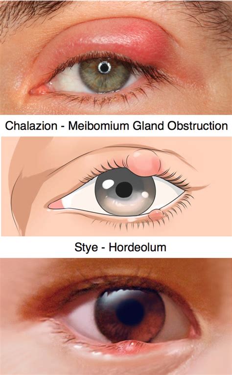 Eyelid Infections Chalazion And Stye Hordeolum