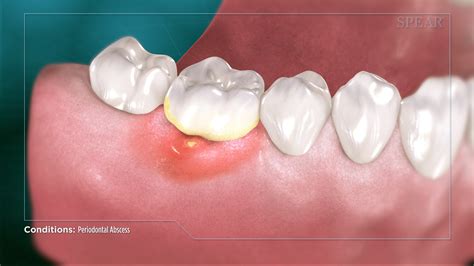 Art Of Joseph Alexander Wraith Periodontal Abscess Growth