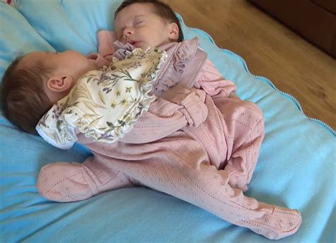 Miracle Conjoined Twins From Ni Are Successfully Separated