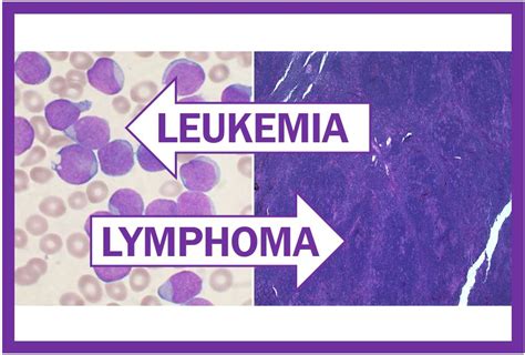 Leukemia And Lymphoma Treatment Where Is It Now