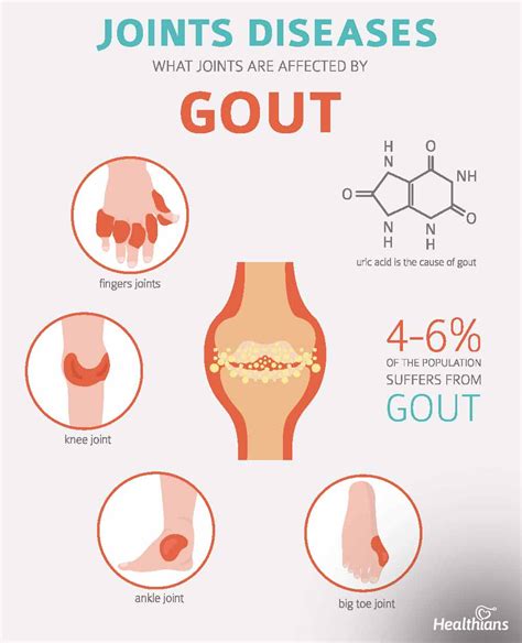 Can Gout Cause An Infection Hot Sex Picture