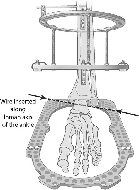 Distraction Arthroplasty Of The Ankle—how Far Can You Stretch The
