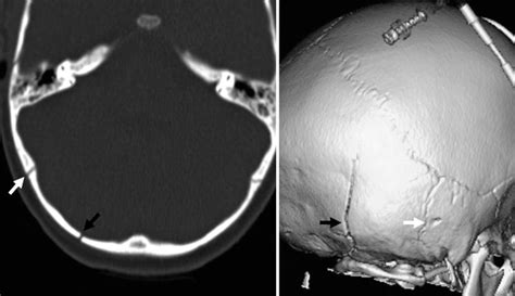 Pediatric Skull Normal Pediatric Sutures On Computed Tomography