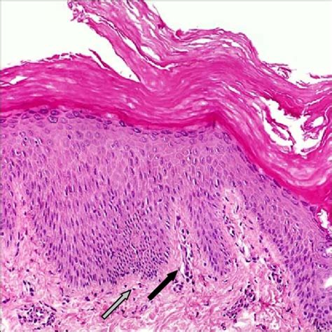Histopathology Of A Psoriatic Plaque Notes Histology Reveals Sexiz Pix