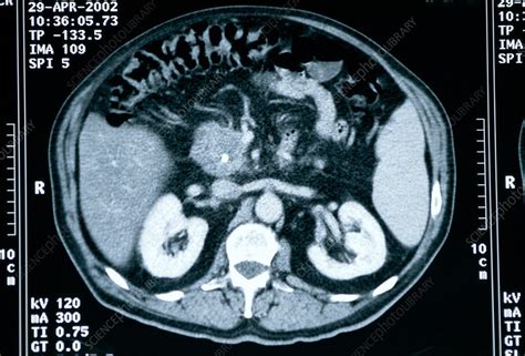 Pancreas Cancer Ct Scan Stock Image M1340463 Science Photo Library