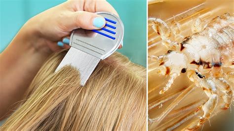 How Short To Cut Hair To Get Rid Of Lice Mitchell Gennusa