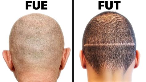FUE Vs FUT Hair Transplant Harvesting YouTube