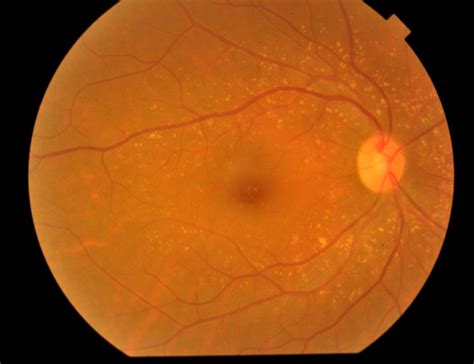 Retinal Fundus Image A Non Cataract B Cataract Download