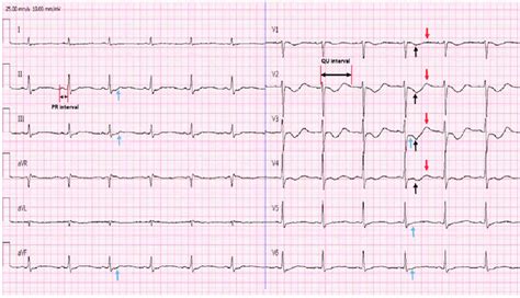 Twelve Lead Electrocardiogram Taken On Admission From A 57 Year Old Man