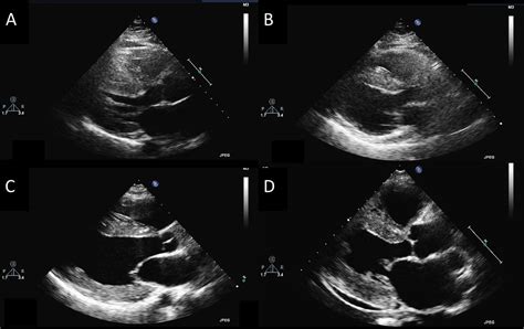 Role Of Echocardiography In The Diagnosis And Management Of