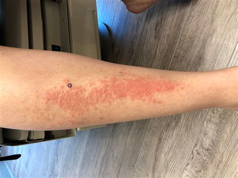 Skin Rashes On Lower Leg Pictures Photos Sexiz Pix