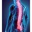 Spinal Decompression  Total Chiropractic Care