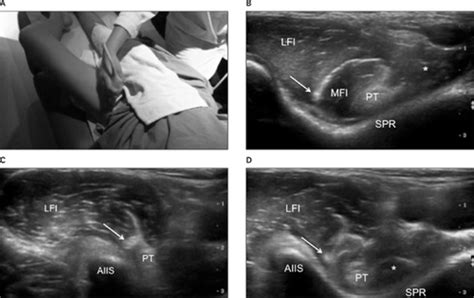 Sonographic Evaluation Of Snapping Hip Syndrome Bureau 2013