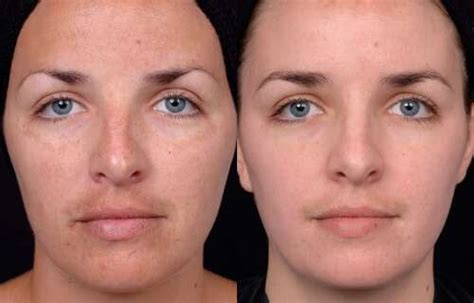 Peeling Facial Tipos Preço Como Funciona E Cuidados Pós Peeling