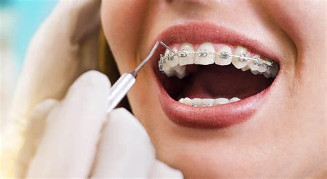 What Is Interceptive Orthodontics
