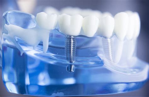 Dental Implants Procedure And Everything About It Healinc Clinic Turkey