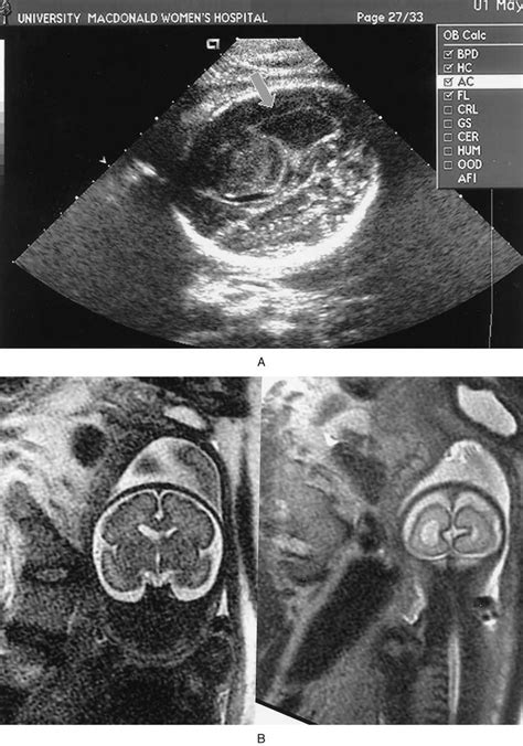 A Abdominal Ultrasound Performed At 25 Weeks For Maternal Fetal Pair
