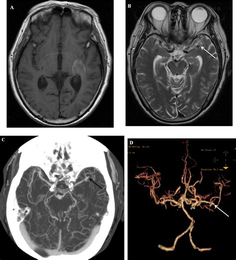 Figure 1 From Subarachnoid Hemorrhage Due To Middle Cerebral Artery