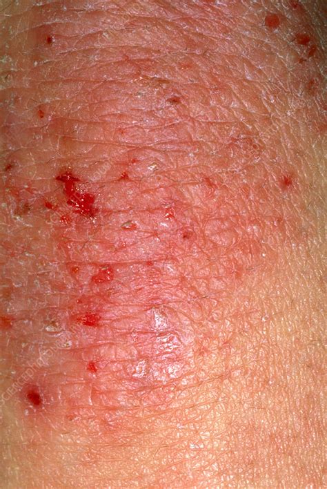 Eczema Stock Image M1500202 Science Photo Library