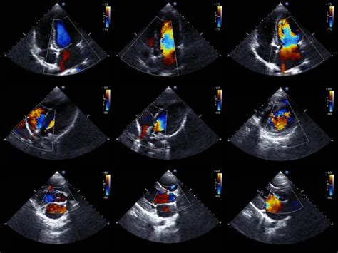 Echocardiogram Definition Uses Procedure And Side Effects Irving