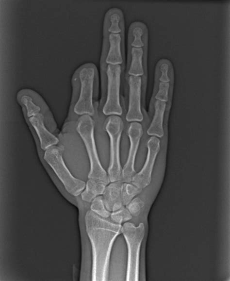 Dorsal View Of Both Hands Showing Normal And Lost Finger Figure 2