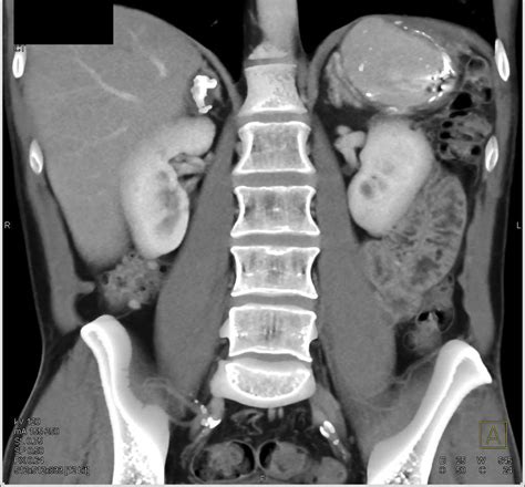 Adrenal Calcifications Due To Prior Inflammation Adrenal Case Studies