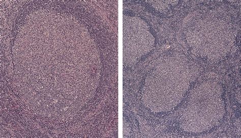 Pathology Outlines Follicular Hyperplasia