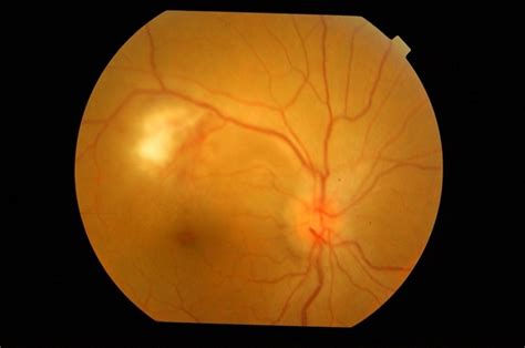 Post Meningitis Retinitis With Papilledema Retina Image Bank