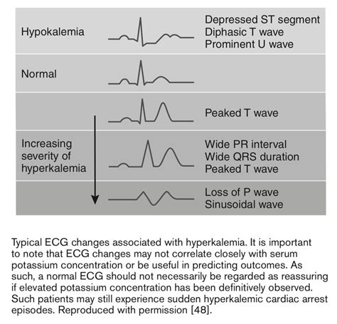 Typical Ecg Changes Associated With Hyperkalemia D06