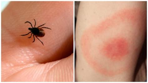 Up To 4 Million Allocated To Fight Lyme Disease Rci English