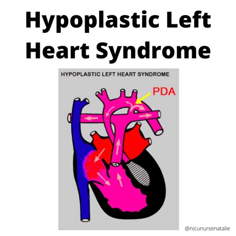 Hypoplastic Left Heart Syndrome Hlhs — The Nurse Natalie