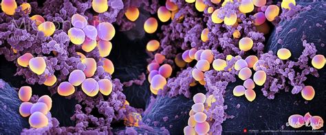 What diseases are caused by staphylococcus aureus? Pin on BACTERIAL