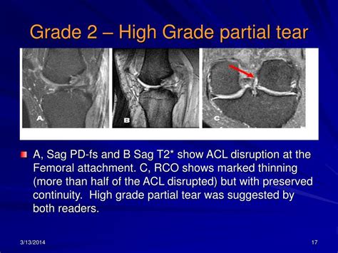 A stretching or tearing of ligament occurs when joints are moved beyond their normal range of motion and the collagen fibers within the ligament are pulled apart. PPT - An Evaluation of the use of reformatted coronal ...