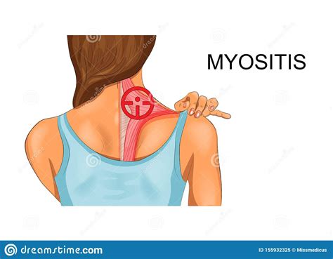 Learn more about its functions and the causes and treatment of trapezius pain. Trapezius De Incidentie Van Myositis Vector Illustratie ...