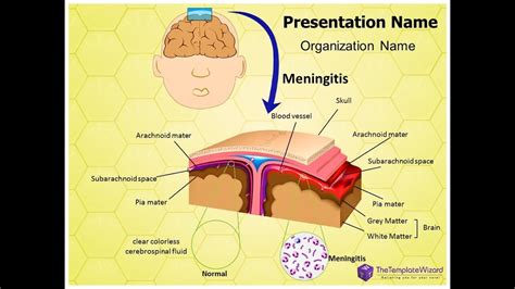 Brain Infection Meningitis Powerpoint Template