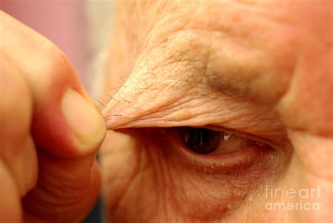 Trichotillomania In Elderly Man Photograph By Scimat Fine Art America