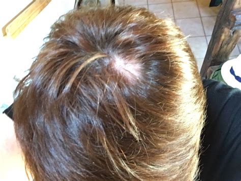 I Have A Bald Patch On My Head Menopause Forums Patient