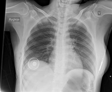 Iatrogenic Pneumothorax As A Complication To Delayed Breast