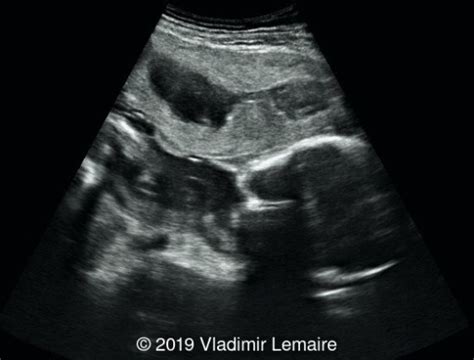 📃 Placental Abruption With Retroplacental Hematoma